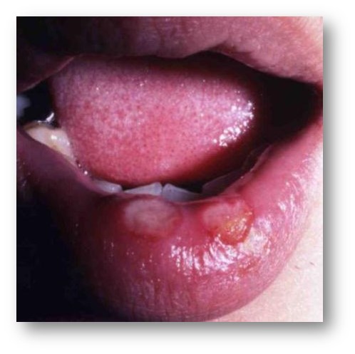 感染から約３週間後、唇にくぼみができている様子の写真