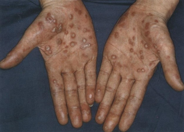 （写真）感染から約３か月後、手のひらに痛くもかゆくもないカサカサした斑点が出ている様子（バラ疹）の写真