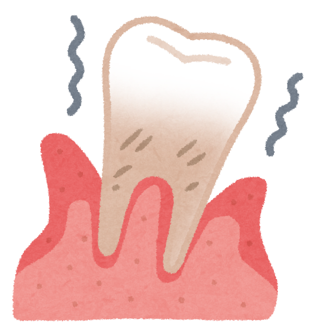 画像:歯周病を表すイラスト