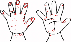 洗い残しが多い部分を赤い点で示した手のイラスト。指先、爪付近、しわ、指輪の周りなどに赤い点が多い。